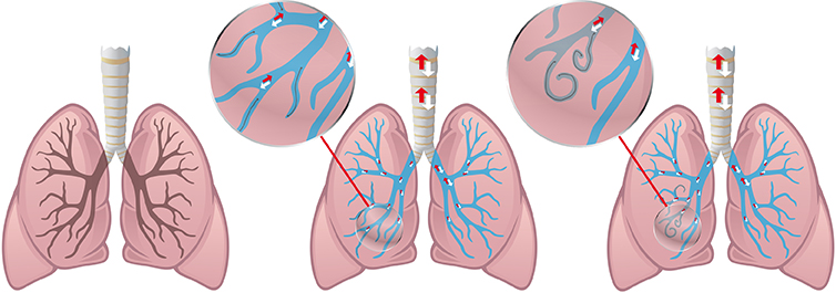 RePneu Coils - Spiralen bei COPD