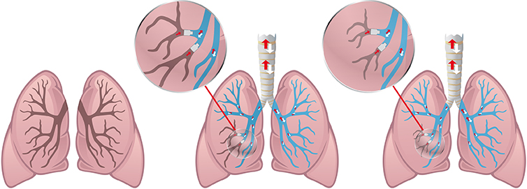 Endobronchialventile - Ventile bei COPD