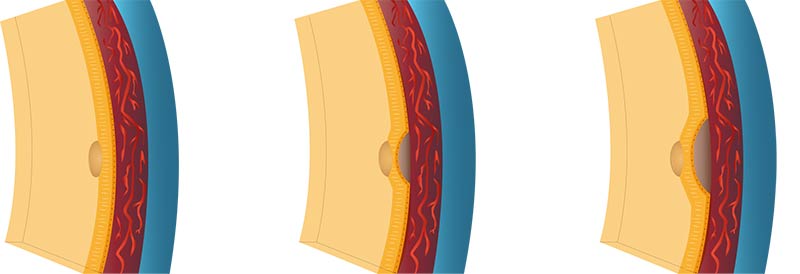 Makuladegeneration - Reparatur- und Schwellungsprozesse zwischen der Netzhaut und Lederhaut